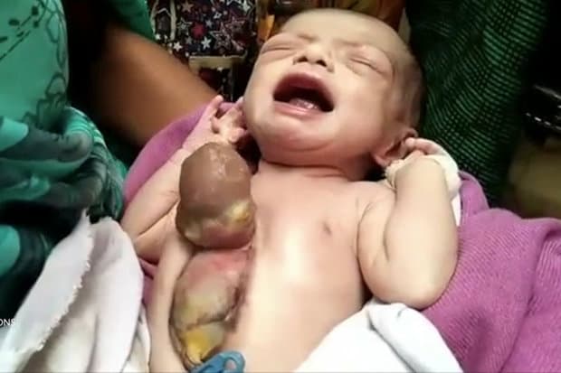 OAV: Hindistonda yuragi tashqarida joylashgan chaqaloq dunyoga keldi