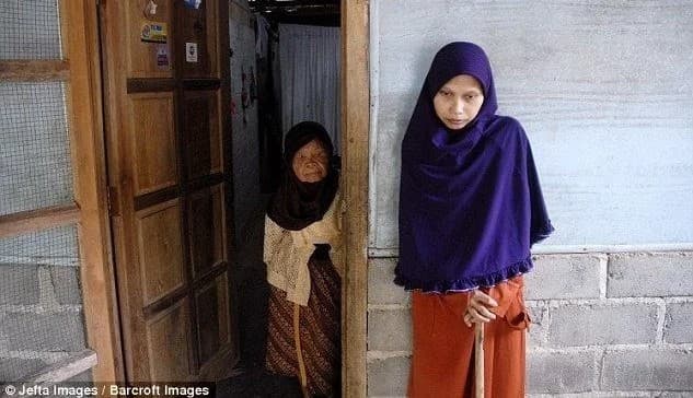 Kamyob kasallik indoneziyalik qizning tanasini taxta kabi qotirib qo‘ydi (suratlar)