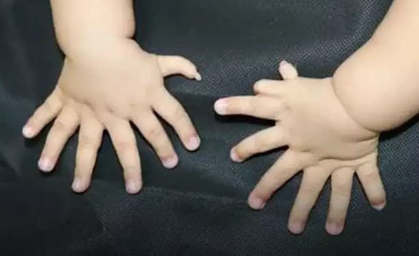 Xitoyda 31 ta barmoqli bola tug‘ildi