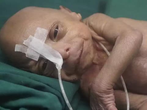 Bangladeshda keksa yoshli odam ko‘rinishidagi chaqaloq dunyoga keldi  