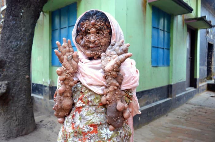 Bangladeshda tanasini o‘simtalar qoplagan ayol hayotdan nolimoqda (asabi bo‘shlar ko‘rmasin)