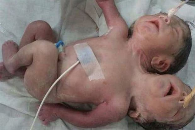 Hindistonda ikki boshli uch qo‘lli chaqaloq dunyoga keldi (foto+video)