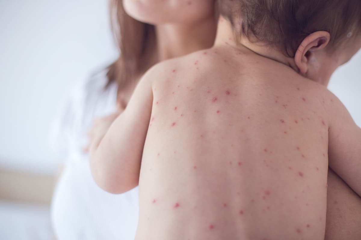 SanEpid Committee: A sharp increase in the number of children with measles has been registered in one of the regions