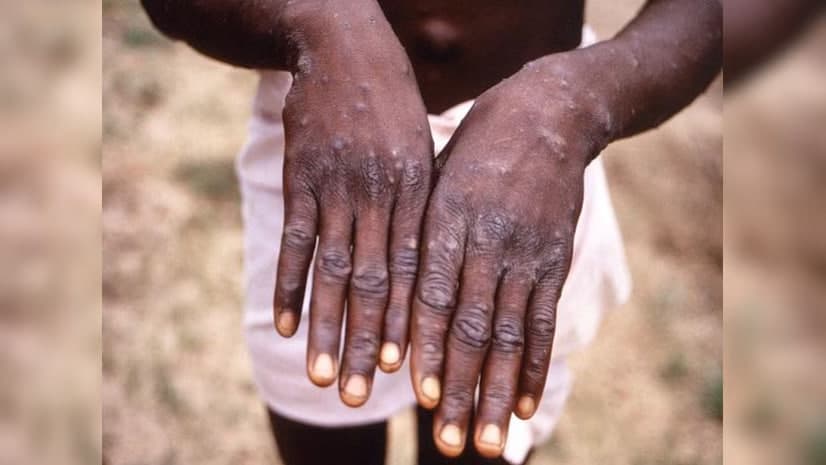 JSST yana bir bor mpox virusi tarqalishi sababli global favqulodda holat e’lon qildi