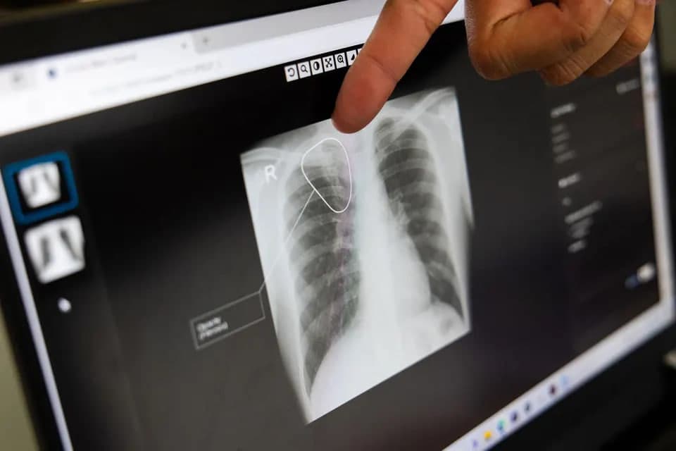 Sil va o‘pka kasalliklariga sun’iy intellekt yordamida tashxis qo‘yiladi – Sog‘liqni saqlash vazirligi