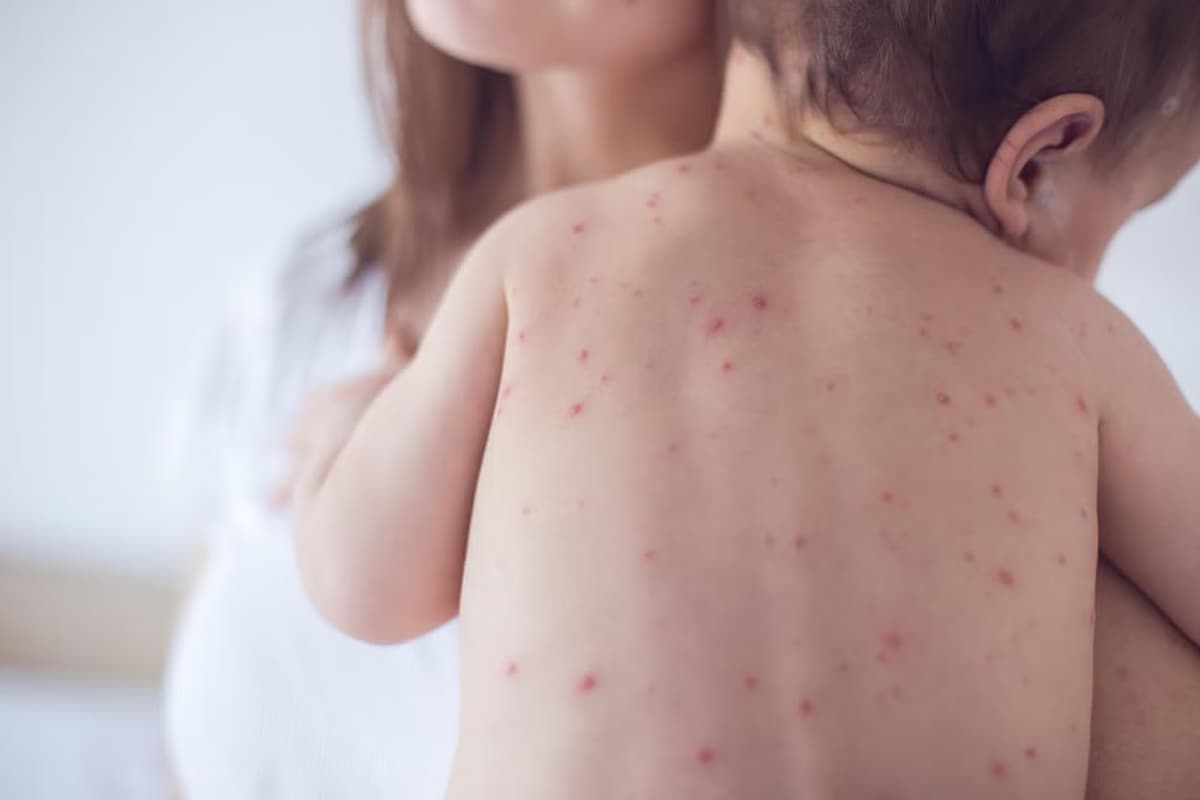 Qizamiq, qush grippi, Mpox: mutaxassis 2026 yilda xavf tug‘dirishi mumkin bo‘lgan viruslardan ogohlantirdi