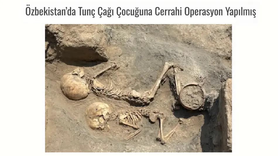 В Узбекистане археологи нашли следы хирургической операции возрастом 4 тысячи лет