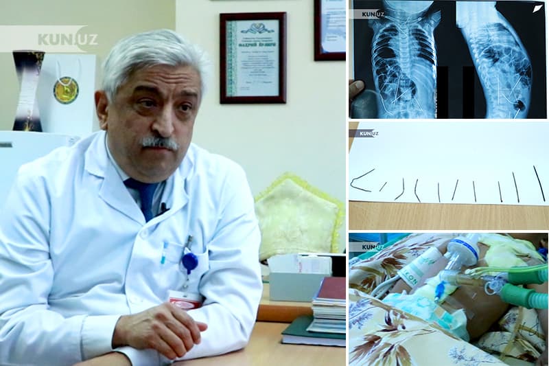 11 oylik chaqaloqning tanasidan 16 dona igna topildi