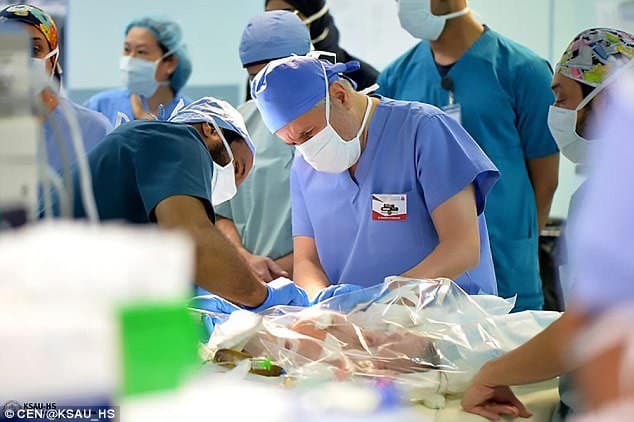 Falastinlik siam egizaklari 15 soat operatsiya qilindi