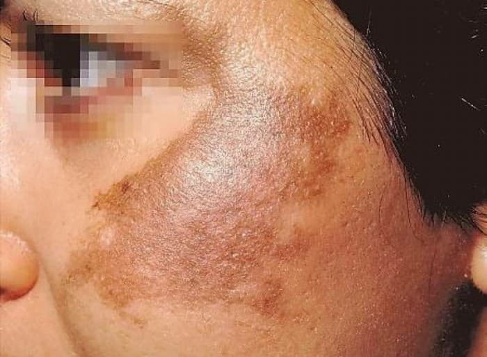 Erkak va ayollardagi pigment dog‘lari, sepkillar va husnbuzarlarga qarshi yechim topildi!