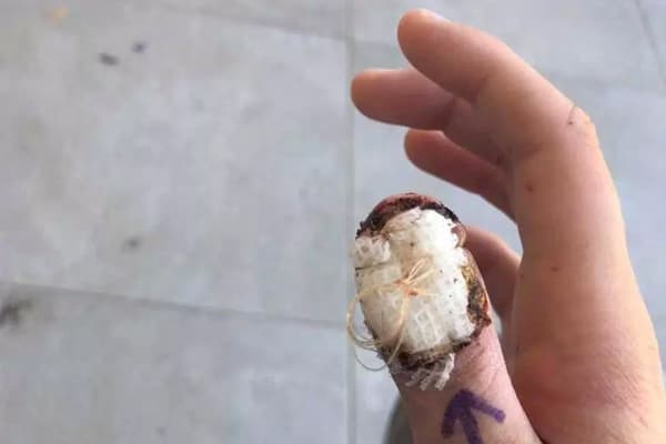 Talaba tirnoqlarni tishlash odati tufayli barmog‘idan ayrildi