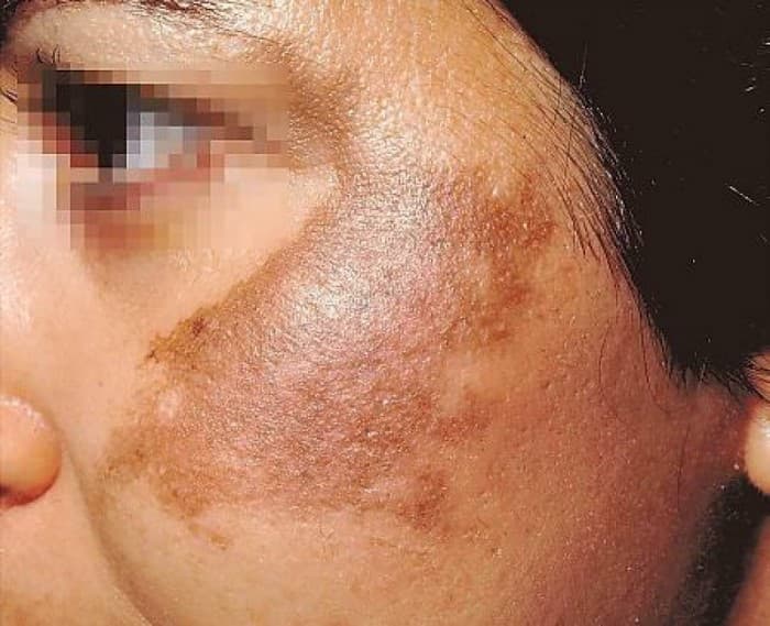Yuzdagi pigment dog‘lar – samarali yechim mavjud!