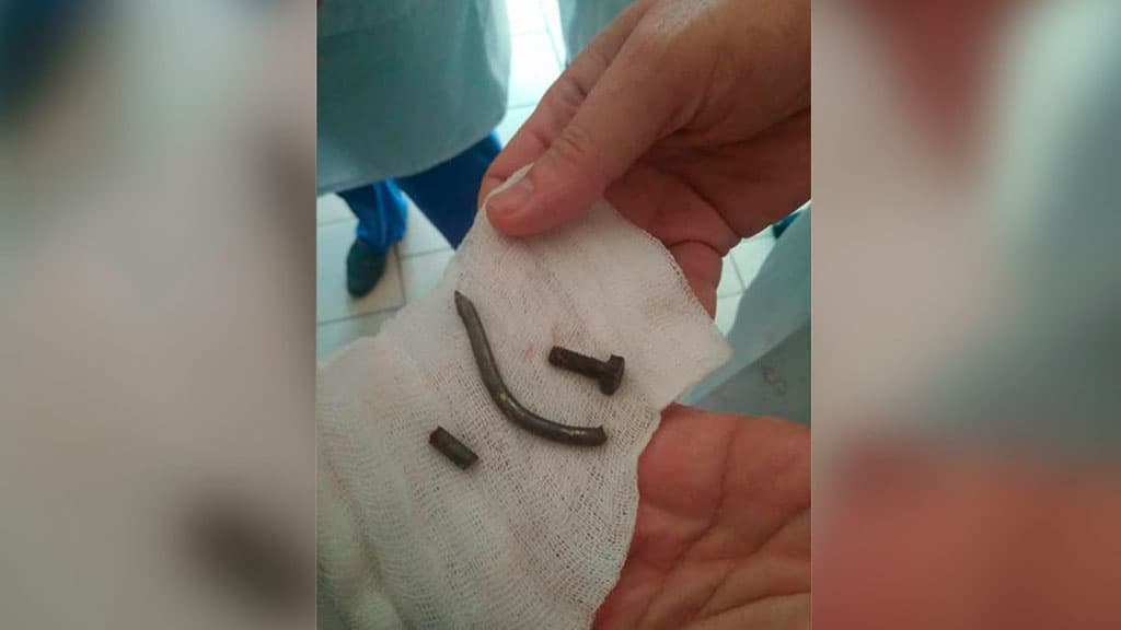 Kerchdagi fojiada jabrlanganlardan birining tanasidan mix va boltlar chiqarib olindi