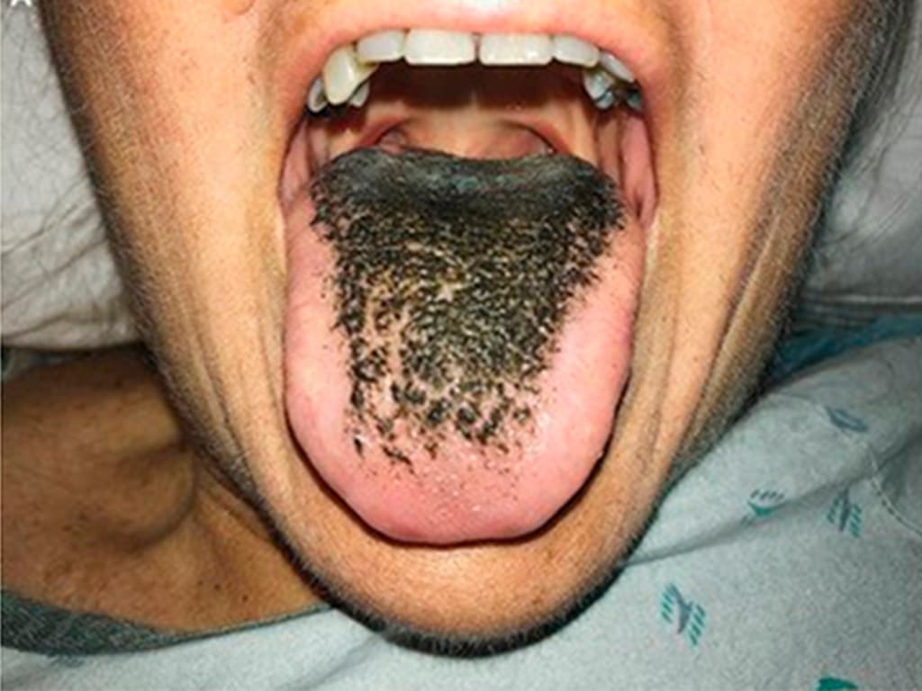 Antibiotiklar amerikalik ayolning tilida “mo‘y o‘sishi”ga olib keldi