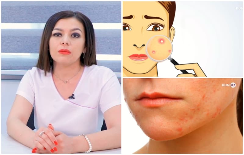 «Husnbuzar orqasidan o‘z joniga qasd qilish ham uchrab turadi. Ular kasallikni davolab bo‘lmaydi deb o‘ylashadi». Dermatovenerolog bilan suhbat