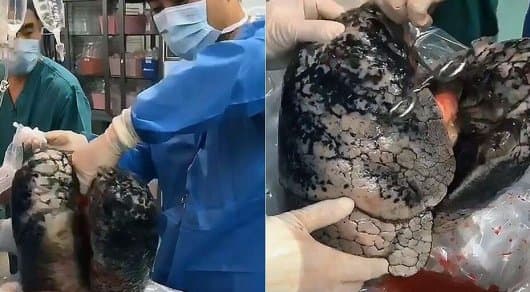 30 yil davomida tamaki chekkan odamning o‘pkasi ko‘rsatildi (video)