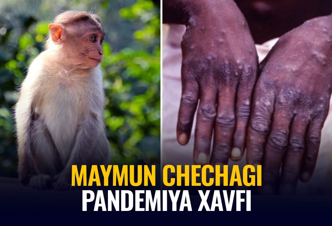 Maymun chechagi: Tez yuqmaydigan va o‘lim ko‘rsatkichi past kasallik nega dunyoni xavotirga solmoqda?