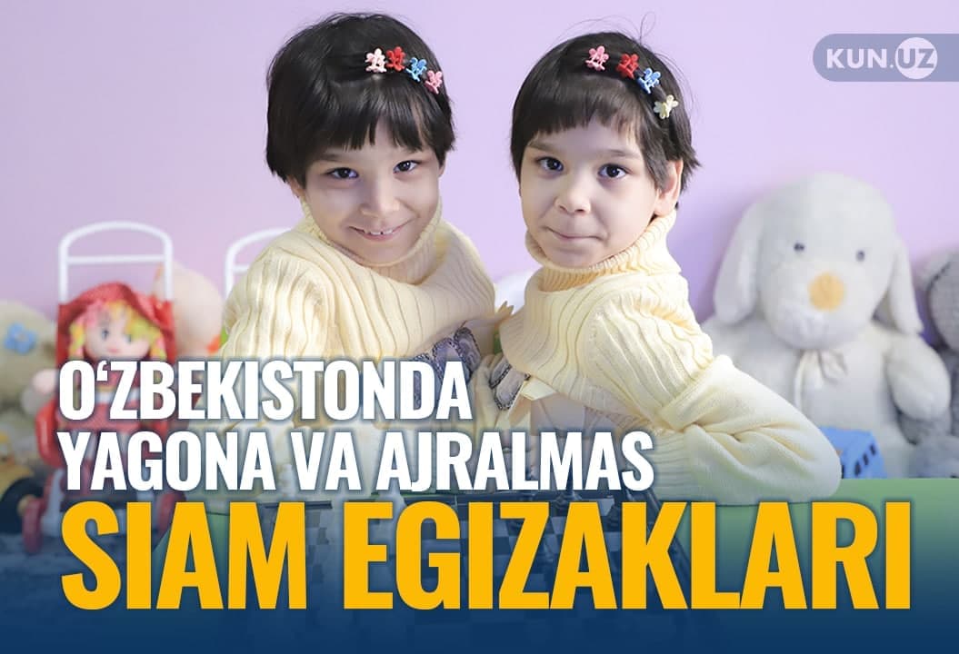 O‘zbekistondagi yagona va ajralmas siam egizaklari