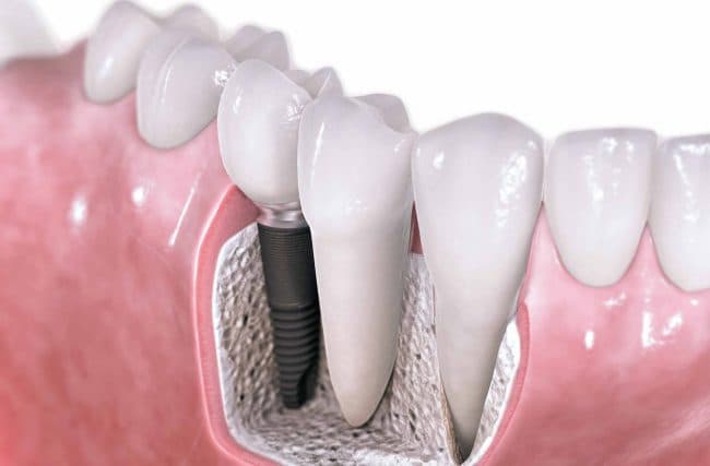 O‘z-o‘zidan suyakka aylanib ketuvchi tish implantantlari yaratildi
