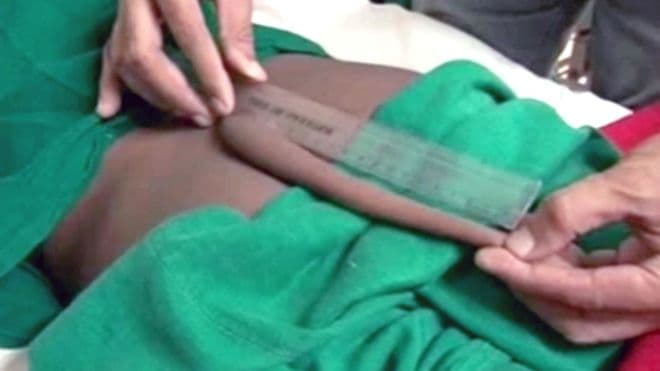 Hindistonlik o‘smirning 20 sm lik dumi olib tashlandi