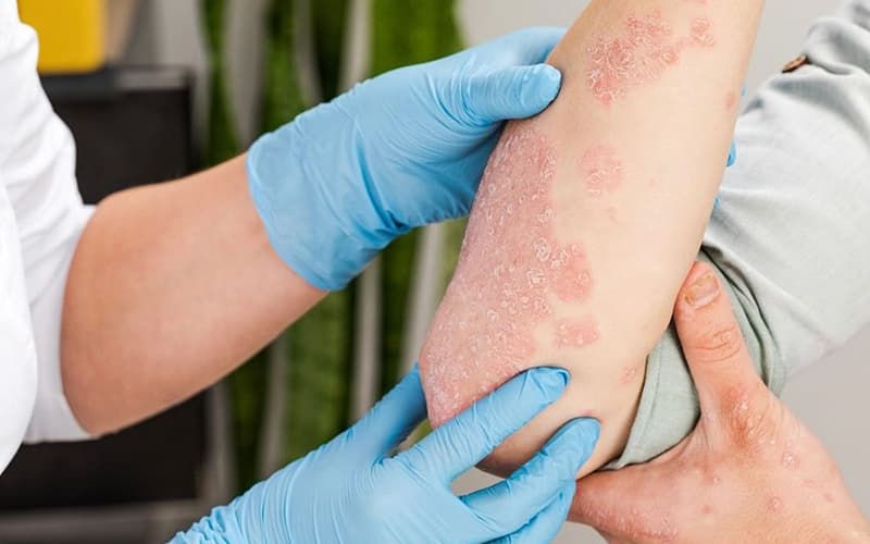 Maktab va bog‘chalarda «temiratki» kasalligi ommaviy tarqalgani rad etildi