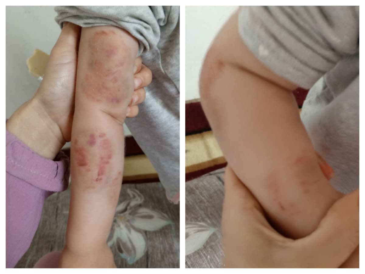 Kattaqo‘rg‘onda bog‘cha tarbiyalanuvchisi jarohatlandi. Uni boshqa bola tishlab tashlagani aytilmoqda