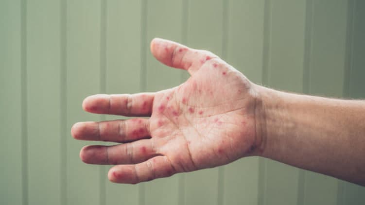 JSST qizamiq epidemiyasi keng tarqalishi ehtimolidan ogohlantirdi