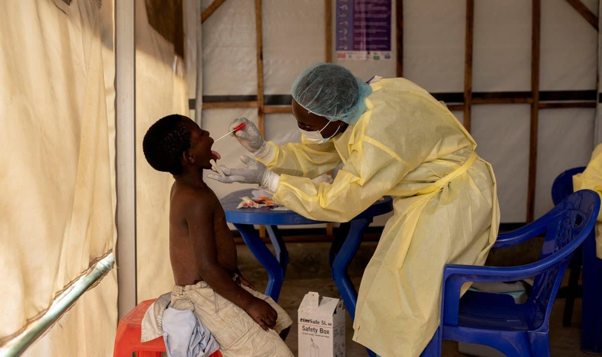 Maymunchechak epidemiyasi koronavirus kabi jiddiy muammo emas – JSST