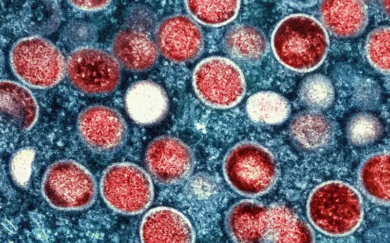Германияда mpox вирусининг хавфли штамми билан касалланганлар аниқланди