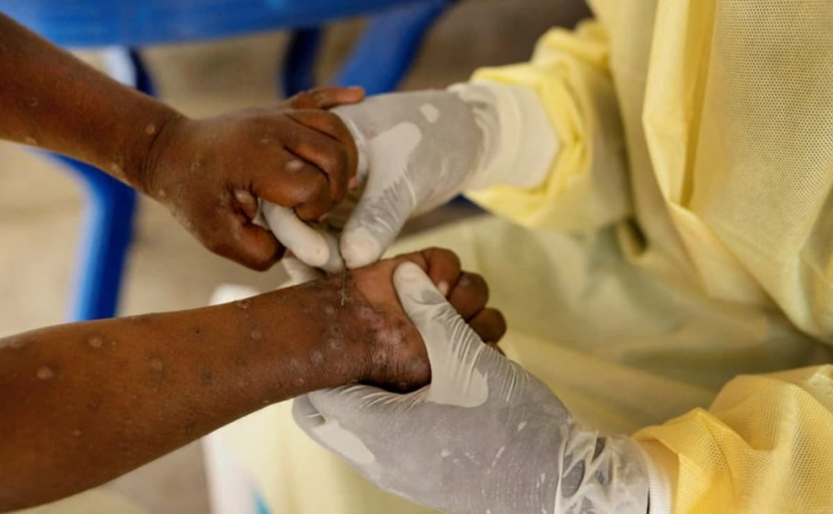 ЖССТ Африкада mpox эпидемиясига қарши курашишга оид тавсияларни тасдиқлади