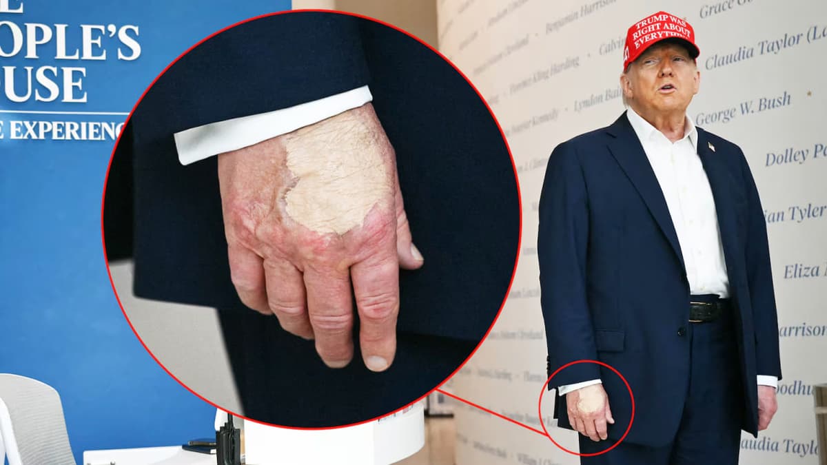 Трамп қўлининг суратлари унинг касаллиги ҳақидаги миш-мишларни кучайтирди