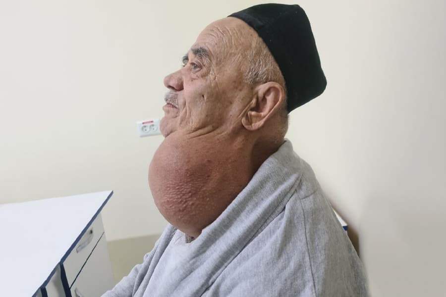Операция в Самарканде: 80-летнему пациенту удалили гигантский зоб