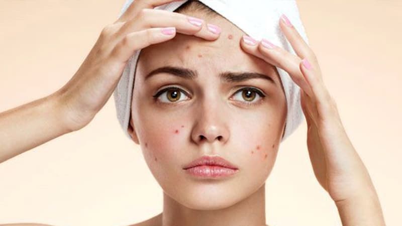 Husnbuzar va uning asoratlaridan «Anti-Acne-Active» bilan oson yechim!