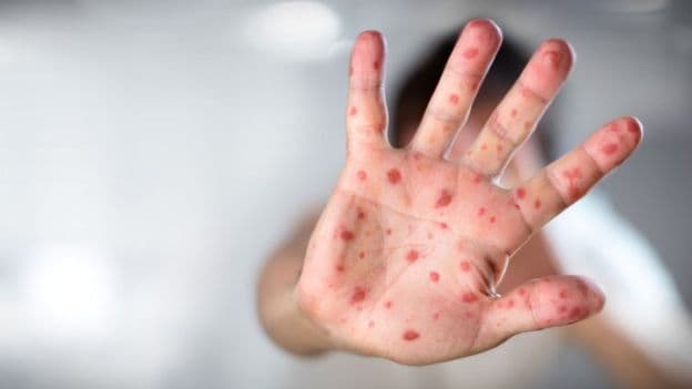 WHO reports a sharp increase in measles cases in several countries, including Uzbekistan